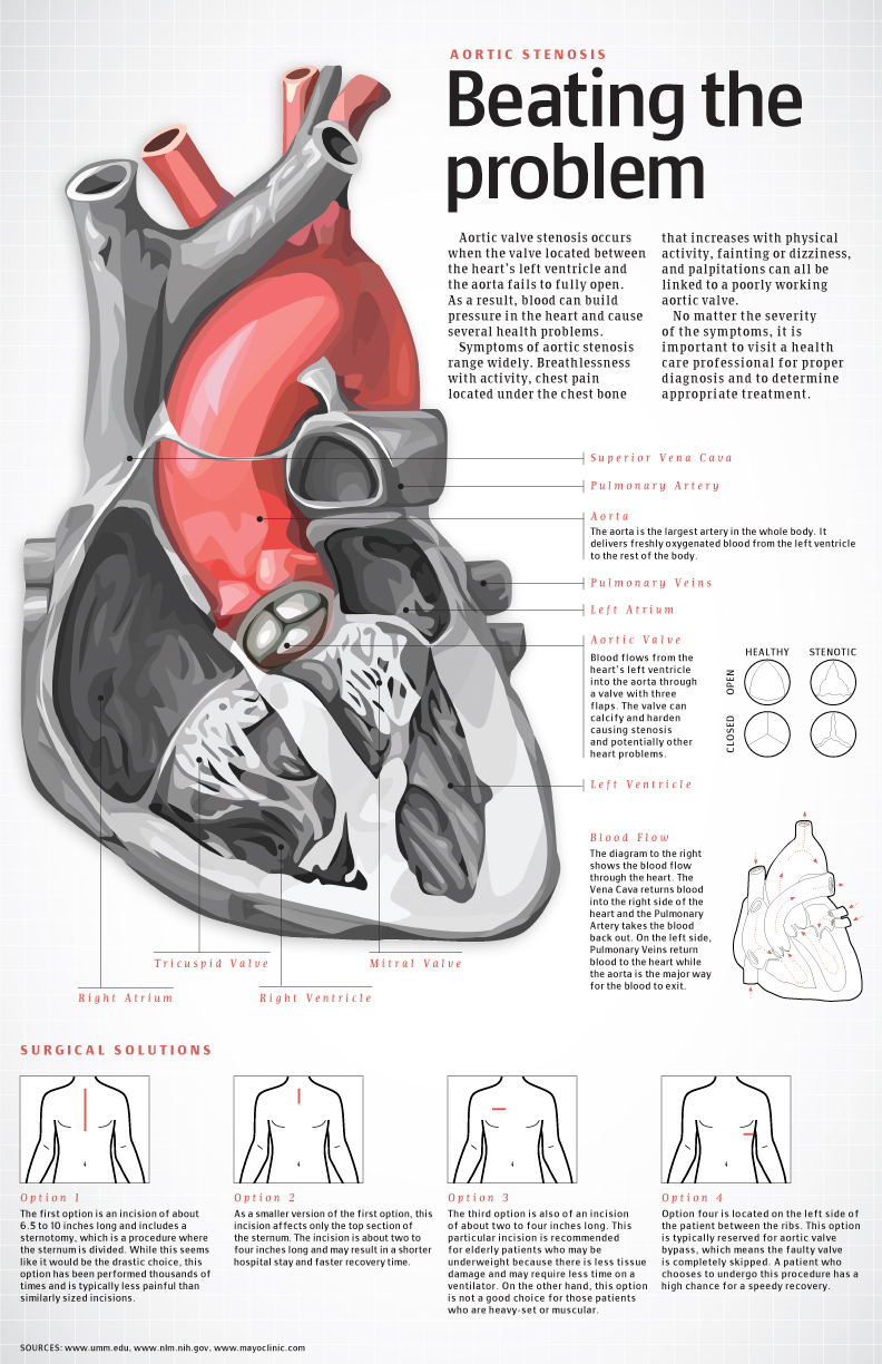 aortic-stencil